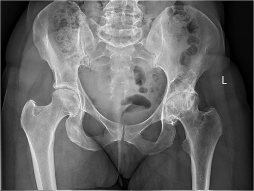 Anterior Hip